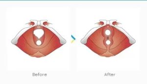 les causes du relâchement vaginal