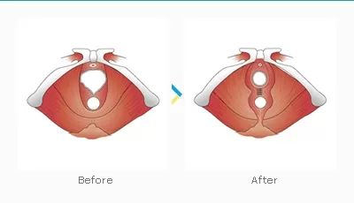 LES 5 PRINCIPALES CAUSES DU RELÂCHEMENT VAGINAL CHEZ LA FEMME