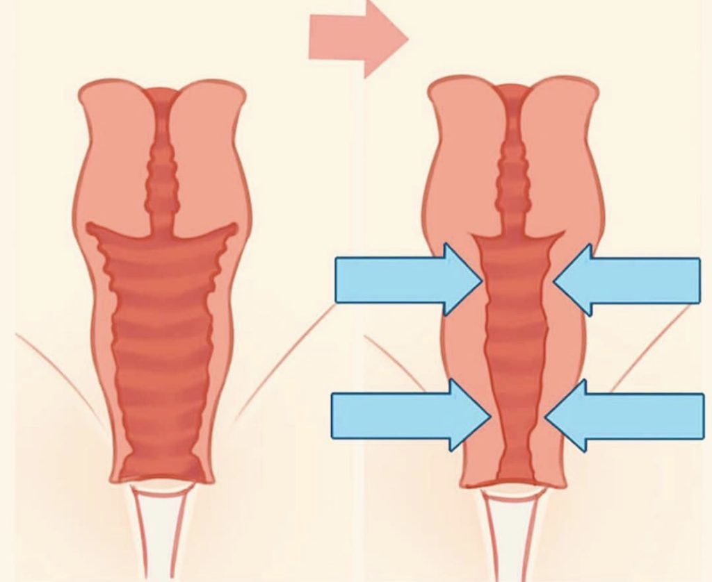 resserrement vaginal avec Emsella