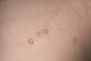 traitement des verrues génitales